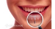 Hướng dẫn thủ tục nhập khẩu nguyên liệu nha khoa?