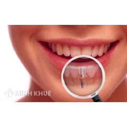 Hướng dẫn thủ tục nhập khẩu nguyên liệu nha khoa?