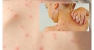 Mắc bệnh thủy đậu thì có phải thực hiện cách ly không?