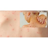 Mắc bệnh thủy đậu thì có phải thực hiện cách ly không?