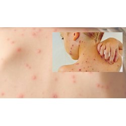 Mắc bệnh thủy đậu thì có phải thực hiện cách ly không?