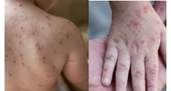 Bộ Y tế hướng dẫn chuẩn đoán và điều trị bệnh thủy đậu