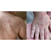 Bộ Y tế hướng dẫn chuẩn đoán và điều trị bệnh thủy đậu