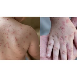Bộ Y tế hướng dẫn chuẩn đoán và điều trị bệnh thủy đậu