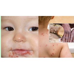 Danh mục các bệnh truyền nhiễm