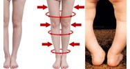 Sau khi thực hiện thủ thuật nắn chỉnh hình tật chân chữ O thì việc xử lý tai biến thế nào?