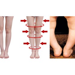 Sau khi thực hiện thủ thuật nắn chỉnh hình tật chân chữ O thì việc xử lý tai biến thế nào?