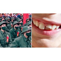 Năm 2024 công dân mất bao nhiêu răng thì không phải đi nghĩa vụ quân sự?