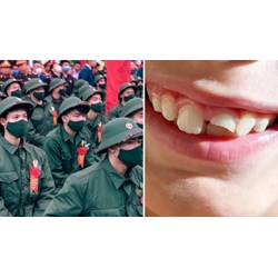 Năm 2024 công dân mất bao nhiêu răng thì không phải đi nghĩa vụ quân sự?