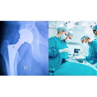 Hướng dẫn bổ sung các vật cấy ghép chỉnh hình trong phẫu thuật và vật liệu từ polyme