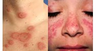 Bệnh lupus đỏ hệ thống có thuộc danh mục bệnh cần chữa trị dài ngày?