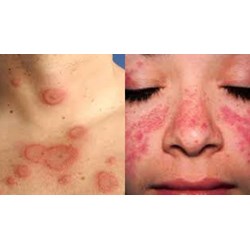 Bệnh lupus đỏ hệ thống có thuộc danh mục bệnh cần chữa trị dài ngày?