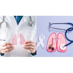 Các nguyên tắc trong việc điều trị bệnh lao phổi kháng thuốc?