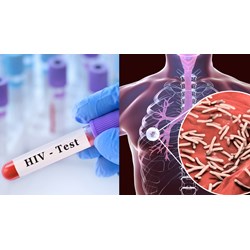 Quy định về tư vấn và xét nghiệm HIV cho người mắc bệnh lao phổi?
