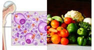 Chế độ dinh dưỡng cho người bệnh đa u tuỷ xương như thế nào?