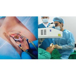 Mổ mắt cận thị có được hưởng bảo hiểm y tế hay không?