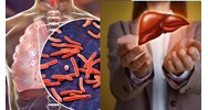 Hướng dẫn điều trị cho người bệnh lao có bệnh lý gan như thế nào?
