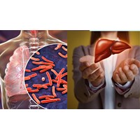 Hướng dẫn điều trị cho người bệnh lao có bệnh lý gan như thế nào?