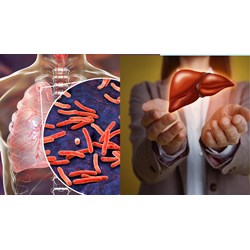 Hướng dẫn điều trị cho người bệnh lao có bệnh lý gan như thế nào?