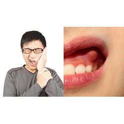 Mách bạn biện pháp khắc phục tại nhà khi bị áp xe răng