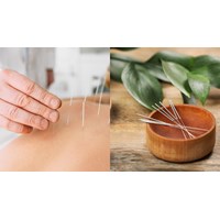 Cách thức hoạt động, lợi ích và kết quả giảm đau của châm cứu