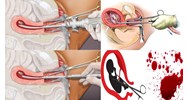 Thời gian nghỉ dưỡng sức sau khi hút thai có tính ngày lễ 30/4 và 1/5