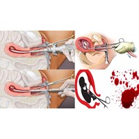 Thời gian nghỉ dưỡng sức sau khi hút thai có tính ngày lễ 30/4 và 1/5
