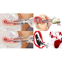 Thời gian nghỉ dưỡng sức sau khi hút thai có tính ngày lễ 30/4 và 1/5