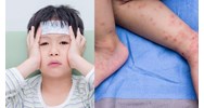 Quy định về nguyên tắc điều trị bệnh Tay chân miệng mới nhất