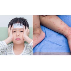 Quy định về nguyên tắc điều trị bệnh Tay chân miệng mới nhất