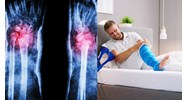 Sau khi nắn bó bột gãy Dupuytren thì có phải theo dõi tiếp tục?