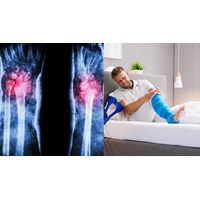 Sau khi nắn bó bột gãy Dupuytren thì có phải theo dõi tiếp tục?