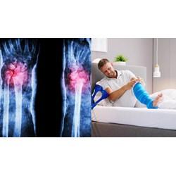 Sau khi nắn bó bột gãy Dupuytren thì có phải theo dõi tiếp tục?