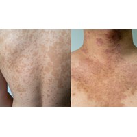 Bị bệnh lang ben khi đi khám nghĩa vụ quân sự thì sức khỏe loại mấy?