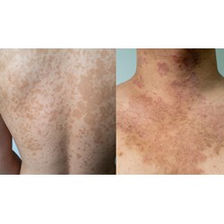 Bị bệnh lang ben khi đi khám nghĩa vụ quân sự thì sức khỏe loại mấy?