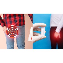 Bị trĩ khi khám sức khỏe nghĩa vụ quân sự sẽ được xếp vào loại mấy?
