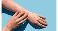 Hướng dẫn về phòng bệnh, điều trị bệnh đậu mùa khỉ