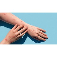 Hướng dẫn về phòng bệnh, điều trị bệnh đậu mùa khỉ