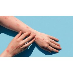 Hướng dẫn về phòng bệnh, điều trị bệnh đậu mùa khỉ