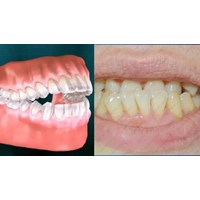 Chẩn đoán lâm sàng và cận lâm sàng sai khớp cắn loại 1 thế nào?