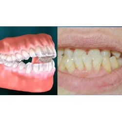 Chẩn đoán lâm sàng và cận lâm sàng sai khớp cắn loại 1 thế nào?