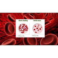 Các mức độ của tình trạng thiếu máu theo hướng dẫn Bộ Y tế