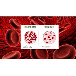 Các mức độ của tình trạng thiếu máu theo hướng dẫn Bộ Y tế