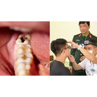 Bị sâu răng thì có được đi nghĩa vụ quân sự theo quy định không?