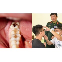 Bị sâu răng thì có được đi nghĩa vụ quân sự theo quy định không?
