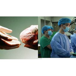 Điều kiện phải đảm bảo với cơ sở y tế ghép bộ phận cơ thể người?