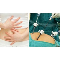 Mổ thai ngoài tử cung được hưởng chế độ ốm đau hay thai sản?