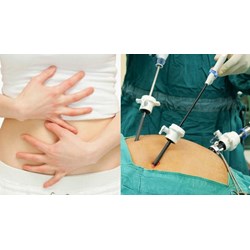 Mổ thai ngoài tử cung được hưởng chế độ ốm đau hay thai sản?