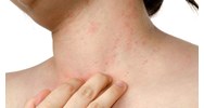 Quy định về các mức độ phản vệ có thể gặp phải khi bị dị ứng?