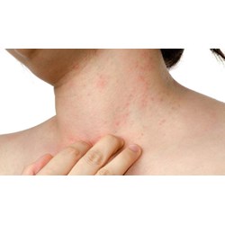 Quy định về các mức độ phản vệ có thể gặp phải khi bị dị ứng?